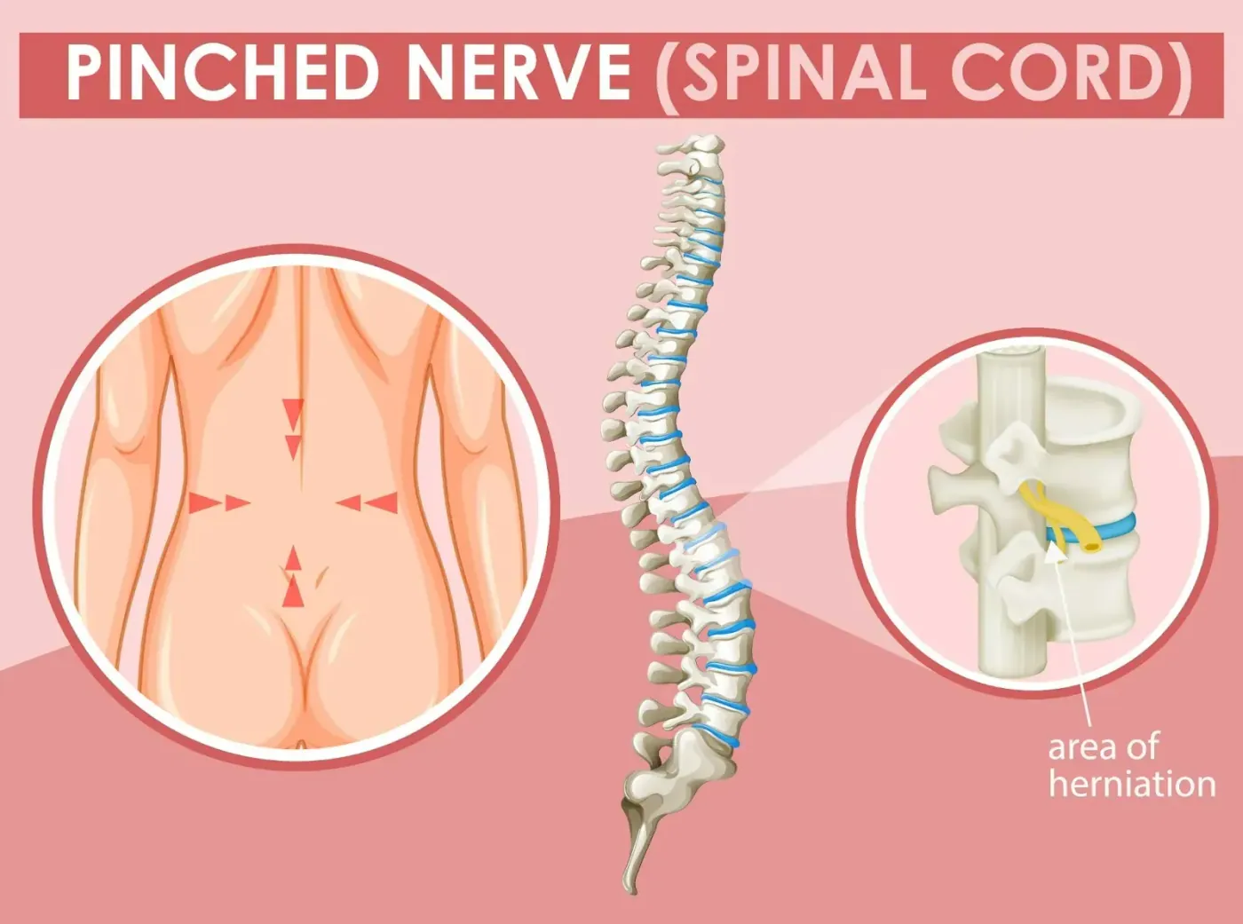 What causes a pinched nerve how chiropractic can help